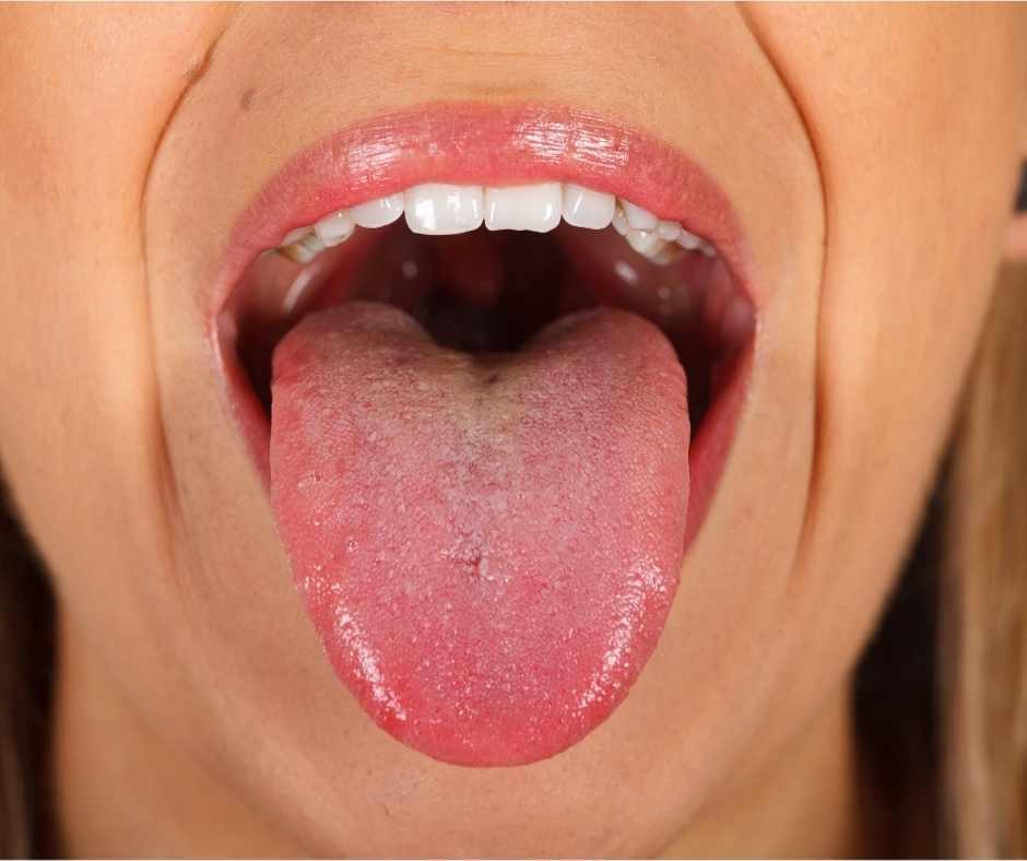 Tongdiagnose