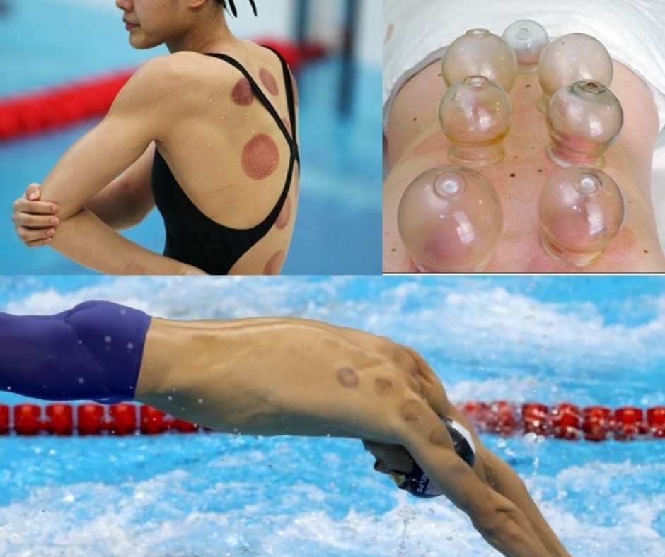 cupping_zwemmers