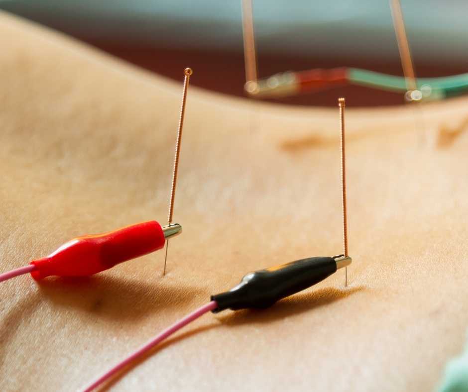 elektroacupunctuur