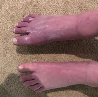 Acupunctuur heeft bij mijn CRPS heel erg geholpen